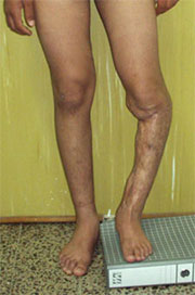 Тяжёлое искривление голени. Лечение деформации конечностей в Израиле