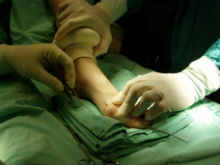 Хирургическое лечение вальгусной деформации стопы